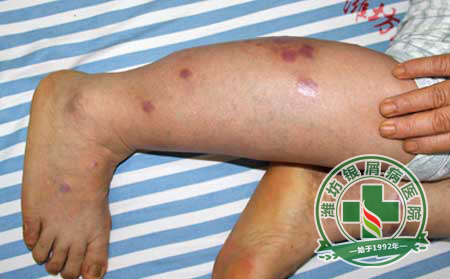 银屑病常识