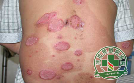 银屑病常识
