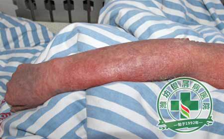 治疗银屑病的误区有哪些?