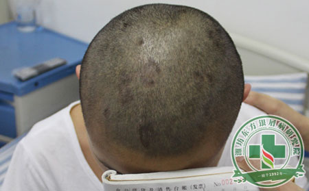 牛皮癣,儿童牛皮癣,牛皮癣治疗