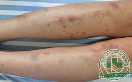 银屑病初期症状