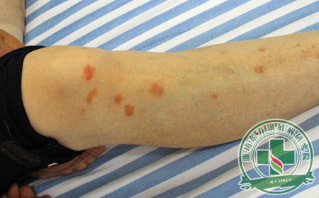 潍坊皮肤病医院介绍银屑病早期发病症状