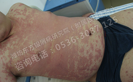 银屑病怎么治疗才危险小