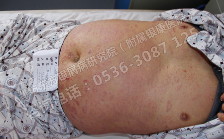 潍坊治疗银屑病的可以方法