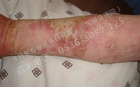 银屑病怎么才能简单治可以