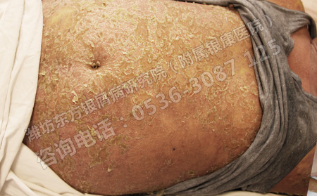 银屑病可以简单治可以吗