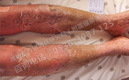 怎样加强银屑病治治治疗效果果果