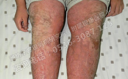 儿童患牛皮癣后如何护理更加可以