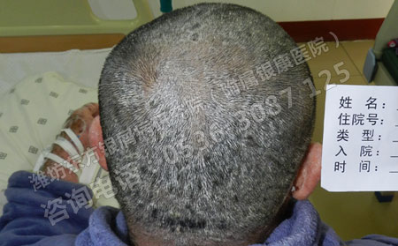 早期头皮牛皮癣该怎么判断