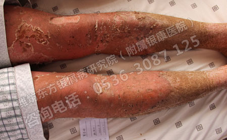 牛皮癣怎么治疗才能减少复发