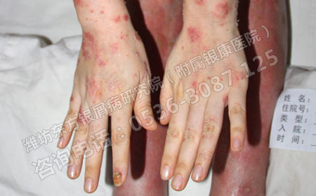 牛皮癣患病初期该怎么进行治疗