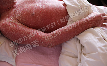 潍坊哪个医院治红皮型牛皮癣可以