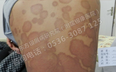 牛皮癣危害性大怎么处理可以呢