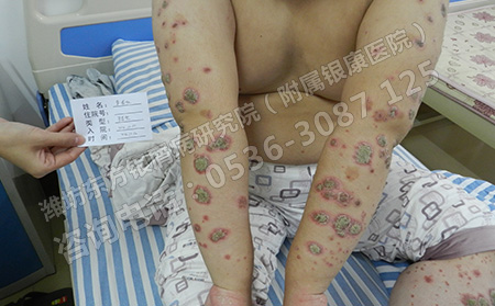 潍坊银屑病发病后怎么治疗呢