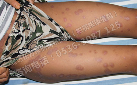 儿童身上出现银屑病要注意什么