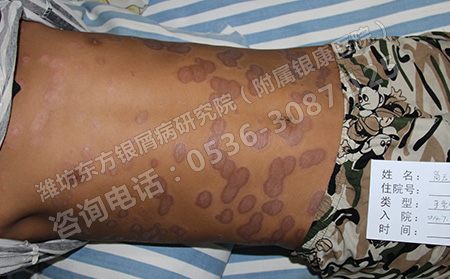 临床治疗银屑病要遵循哪些原则