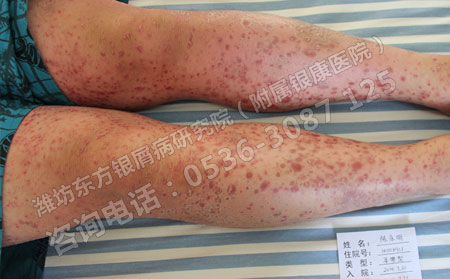 治疗银屑病比较可以的方法是什么呢？