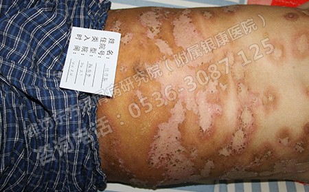 儿童银屑病患者如何注意饮食问题