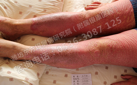 治疗银屑病要选择一家怎样的医院