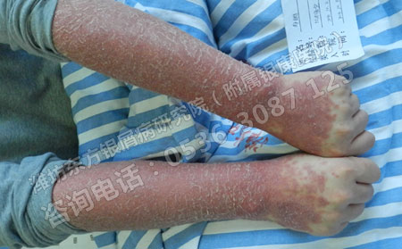 儿童为什么也会患上银屑病