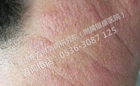 银屑病患者在日常饮食中吃什么