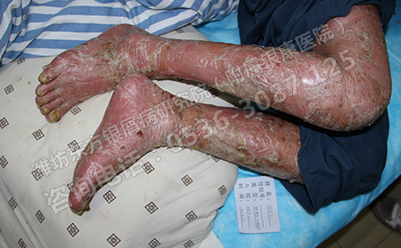 银屑病患者的指甲要如何清洁