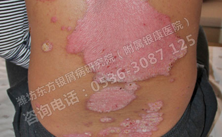银屑病在治疗的同时如何做可以护理