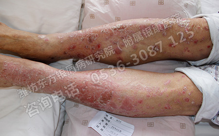 潍坊银屑病会给患者带来哪些哪些身体上的损害
