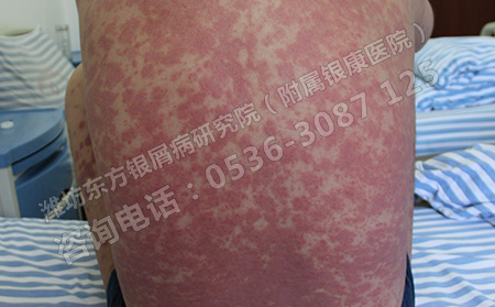 青少年银屑病要怎么治疗比较可以