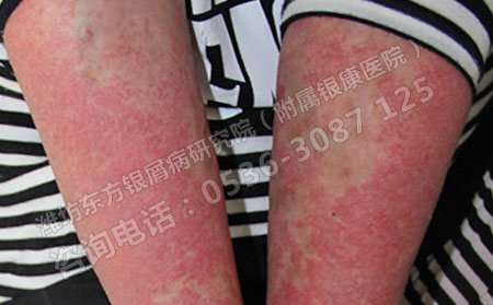 牛皮癣对女性患者的影响主要有哪些？