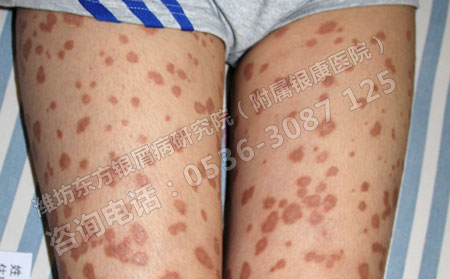 女性患上银屑病该怎么治疗可以