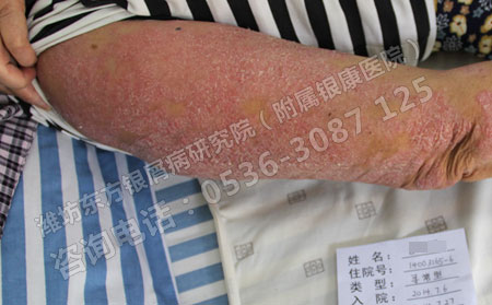 牛皮癣怎么治疗可以达到理想的效果