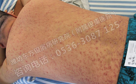 哪种治疗方法可有效去除银屑病皮损