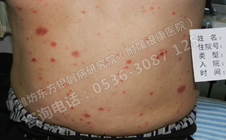 寻常型银屑病的护理工作该如何进行