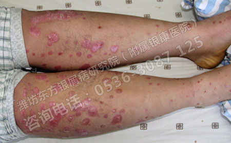 治疗儿童银屑病有哪些需要注意？