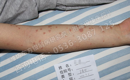 寻常型银屑病病因主要与哪些因素有关