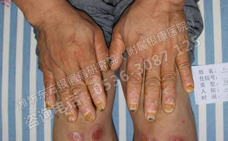 治疗银屑病需要患者身心同治