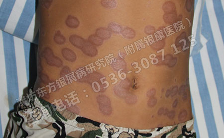 我们应当如何治疗小孩银屑病呢