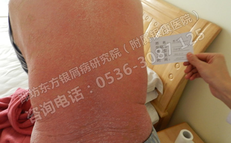 临床护理银屑病的常见方法有哪些呢