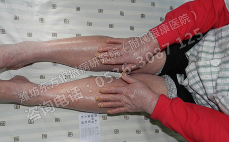 患了银屑病使用哪种方法治疗比较可以