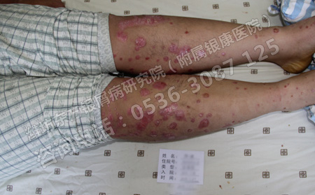 预防银屑病有哪些常用的方法呢
