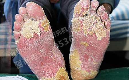 治疗男性牛皮癣有哪些可以的方法吗