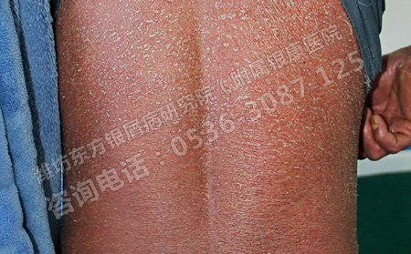牛皮癣的诱发因素到底有哪几个呢