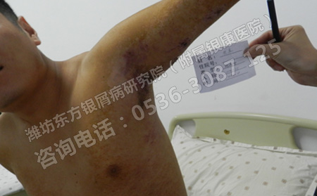怎么样牛皮癣才不会复发了呢
