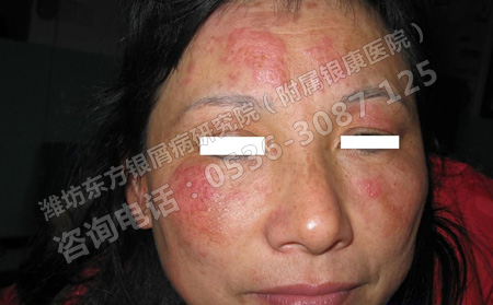 潍坊哪个皮肤病医院治疗牛皮癣可以