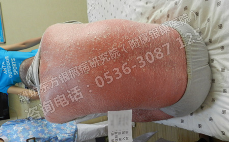 潍坊皮肤病医院怎么治疗牛皮癣