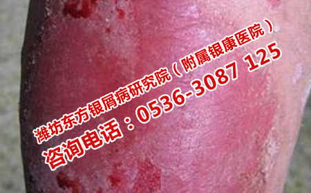 牛皮癣为什么时不时复发