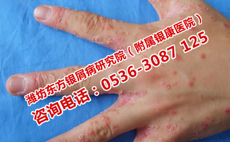 潍坊皮肤病医院怎样治疗银屑病
