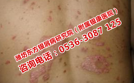 潍坊皮肤病医院怎样治疗银屑病