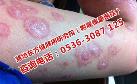 潍坊皮肤病医院怎样治疗牛皮癣